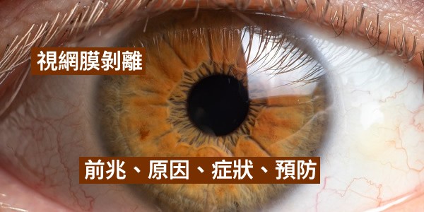 視網膜剝離有何前兆？原因幾何？症狀是什麼？怎預防？