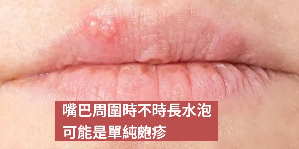 嘴巴周圍時不時長水泡，不一定是上火，還可能是單純皰疹