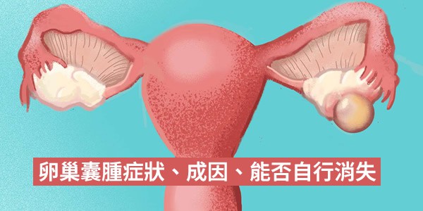 卵巢囊腫症狀怎樣？成因是什麼？會自己消嗎？超音波能診斷嗎？