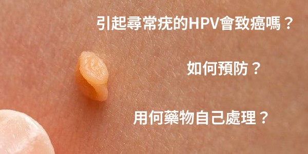 引起尋常疣的HPV會致癌嗎？如何預防？長疣後用何藥物自己處理？