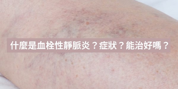 什麼是栓塞性静脉炎？症狀有哪些？能治好嗎？