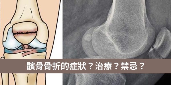 髕骨骨折的症狀是怎樣的？治療怎麼選擇？有何禁忌？