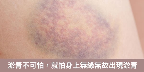 有明確原因的淤青不可怕，就怕身上無緣無故出現淤青