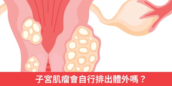 子宮肌瘤會自行排出體外嗎?